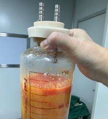 衡东水动力吸脂手术要做多久？